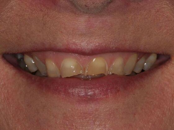 Before