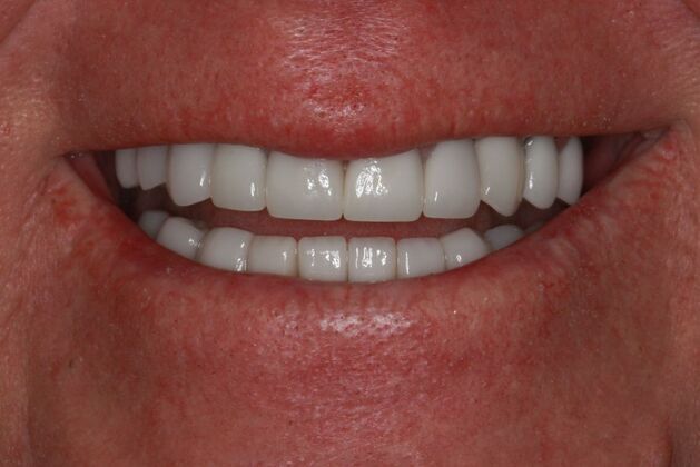 patient after veneers