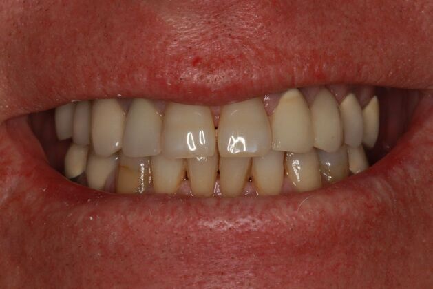 patient before veneers